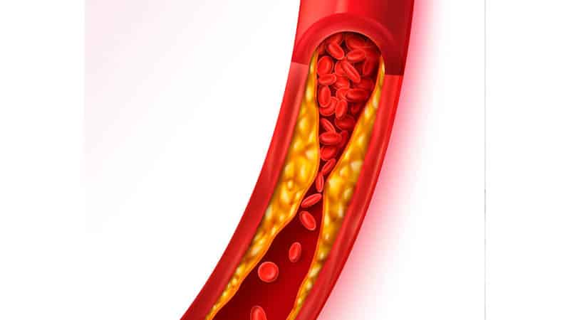 Koroner arter hastalığı nedir, neden olur? Belirtileri ve tedavisi